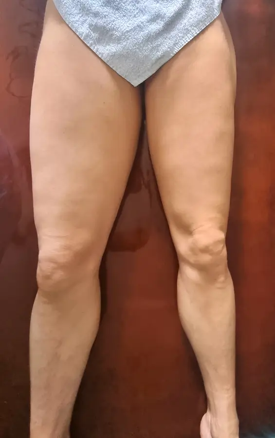 Resultado de tratamiento corporal, imagen 10 (sin identificar a la persona)