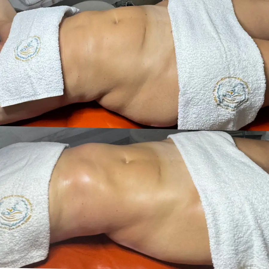 Resultado de tratamiento corporal, imagen 12 (sin identificar a la persona)
