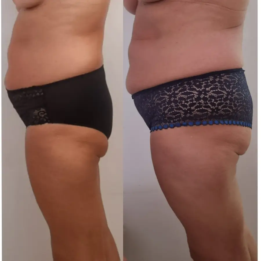 Resultado de tratamiento corporal, imagen 21 (sin identificar a la persona)