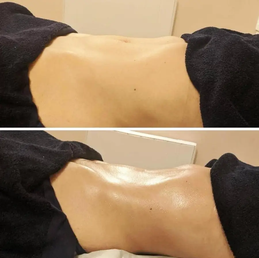 Resultado de tratamiento corporal, imagen 29 (sin identificar a la persona)