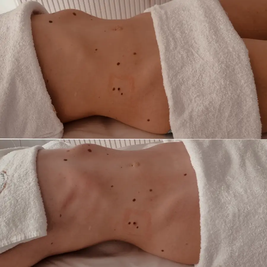 Resultado de tratamiento corporal, imagen 51 (sin identificar a la persona)