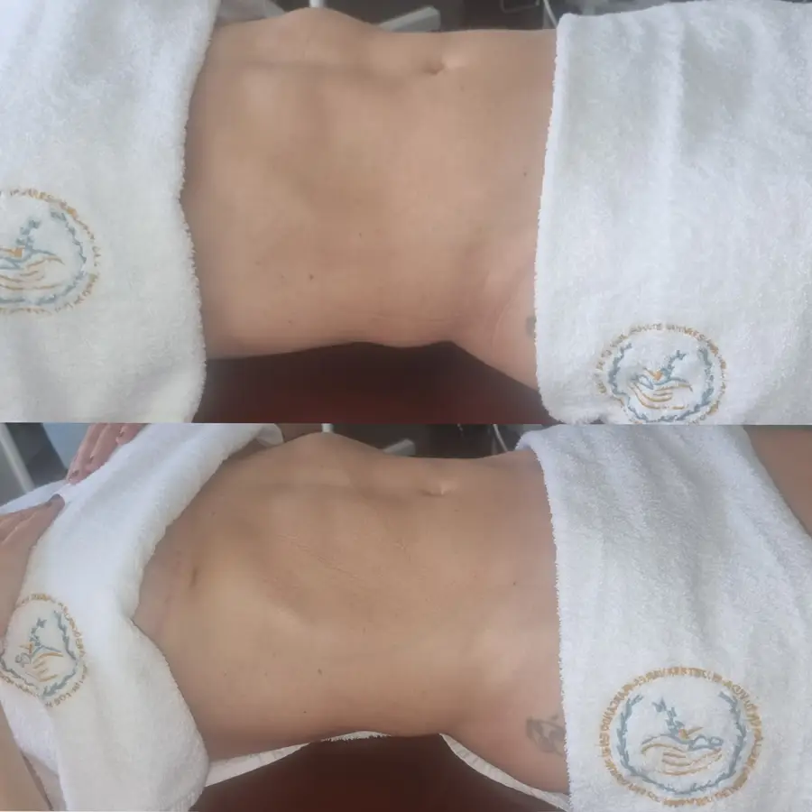 Resultado de tratamiento corporal, imagen 56 (sin identificar a la persona)