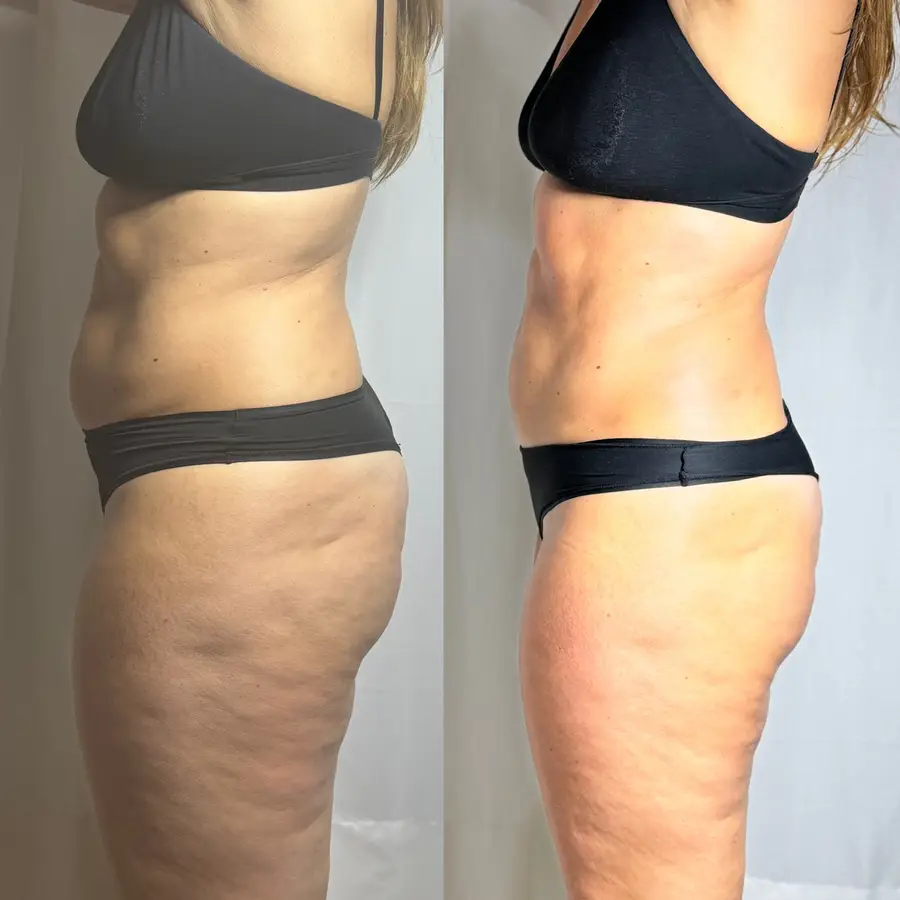 Resultado de tratamiento corporal, imagen 70 (sin identificar a la persona)