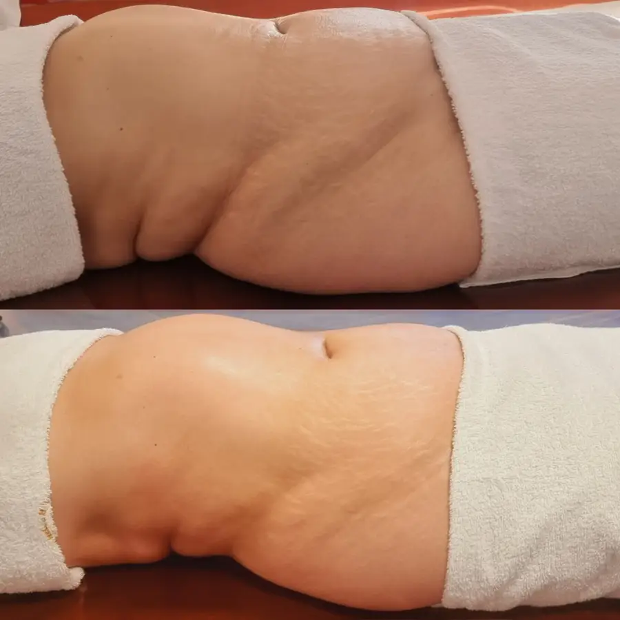 Resultado de tratamiento corporal, imagen 72 (sin identificar a la persona)