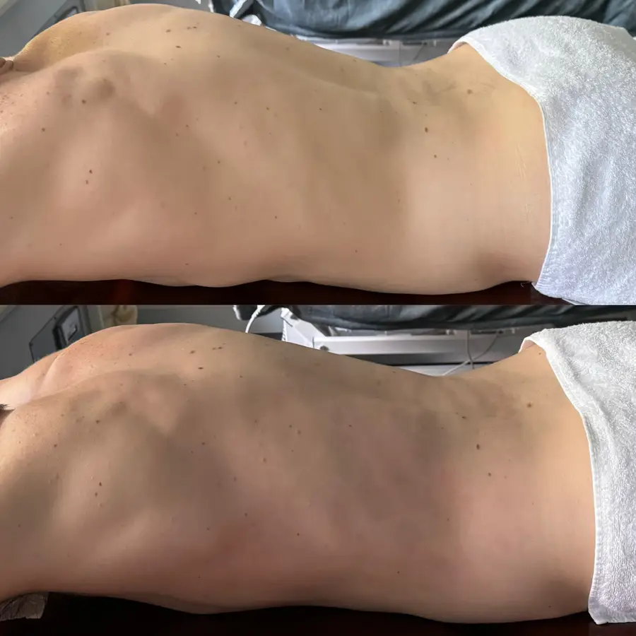 Resultado de tratamiento corporal, imagen 75 (sin identificar a la persona)